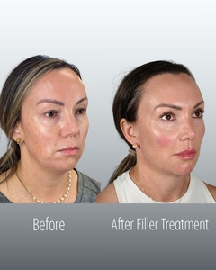 Filler B/A CL Right Oblique-before