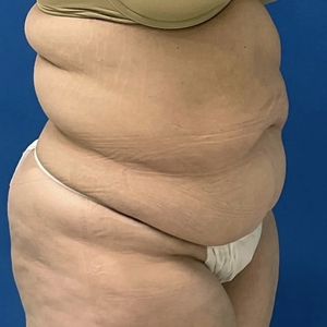 Tummy Tuck #14-before