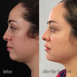 Filler B/A SBA 14-before