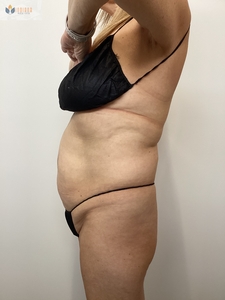 2 Treatments of Insta Abd-before