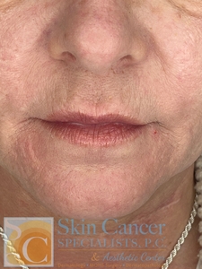 Patient had filler to lips and around mouth.-before