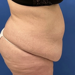 Tummy Tuck #1-before