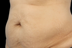 4 Treatments-before