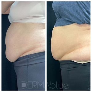 CoolSculpting-before