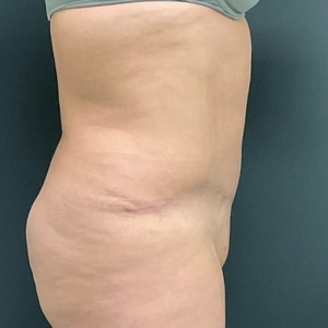 Tummy Tuck #13-after