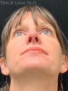 Rhinoplasty - Traditional-after