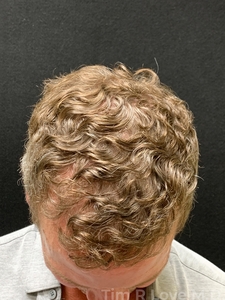 3000 grafts-after