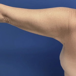 Lipo w Renuvion #4-after