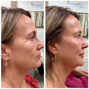 Botox-before