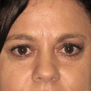 Brow & Eye Lift #5-before