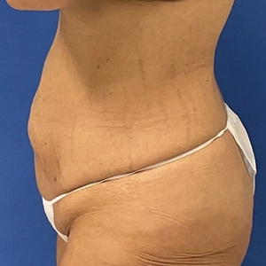 Tummy Tuck #3-before