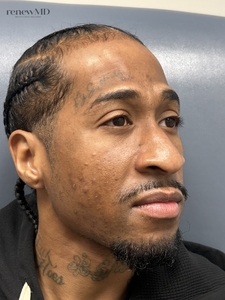 MIRCONEEDLING PRP-before