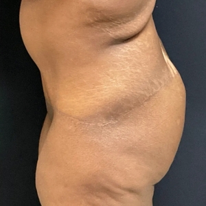 Tummy Tuck #18 (left)-after