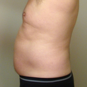 Liposuction #3-before