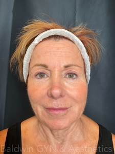 lower face only-after