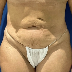 Tummy Tuck #5-before
