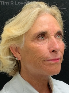 1 year post op face and neck lift, Morpheus8, Fraxel, Nanofat, Sculptra, Lip filler-after