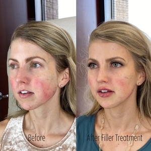 Filler B/A SBA 11-before