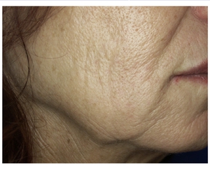 Dermal Thickening-before