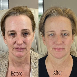 Filler B/A SBA 34-before