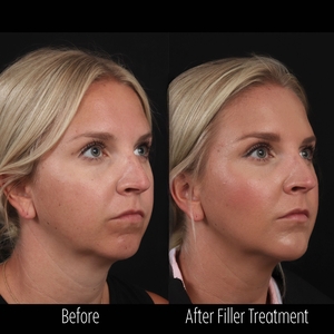 Filler B/A SBA 6-before