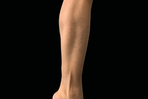 4 Treatments-after
