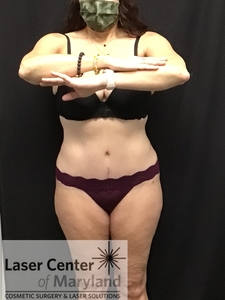 Tummy Tuck w/ vertical slit-after