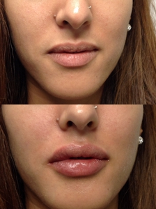Lip Filler-before