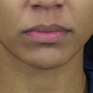 Chin Filler-before