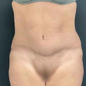 Tummy Tuck #13-after