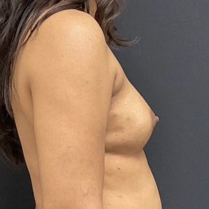 Breast Augmentation #14 325/350 cc-before