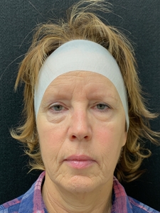 11 months post Morpheus8/Nanofat x3, Sculptra, 1 syringe Versa filler-before