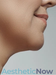 Kybella-after