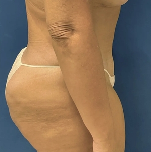 Tummy Tuck #5-after
