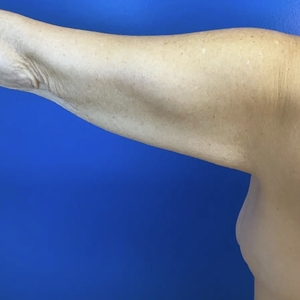 Lipo w Renuvion #4-before