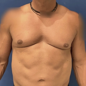 Male Breast Reduction #4 (front)-before
