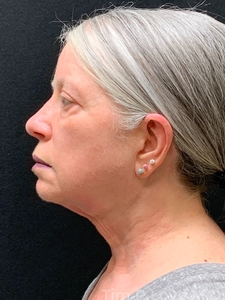 MyEllevate with Upper Bleph-after