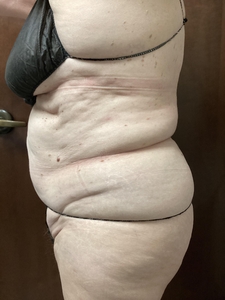 4 weeks after 6th Edge Session-before