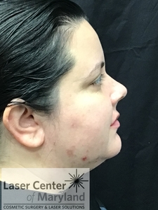 Submental Liposuction with ThermiTight-before