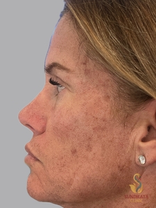 One week post NOUVADerm Mod ablation with spot treatment to pigmentation-after