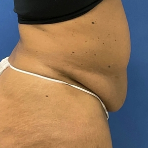 Lipo w Renuvion #6-before