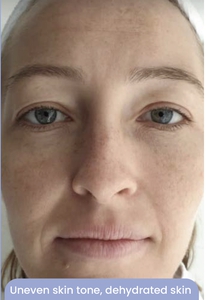 Uneven skin tone, dehydrated skin-before