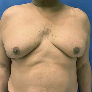 Male Breast Reduction #2-before