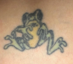 Laser Tattoo Removal #1-before