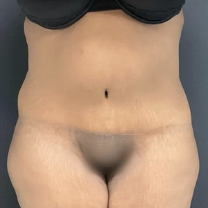 Tummy Tuck #18 (front)-after