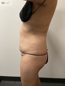 6 Sessions! Insta & Cryo Abd-after