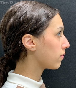 1 month post op-before