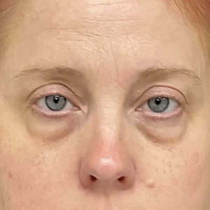 Brow & Eye Lift #4-before