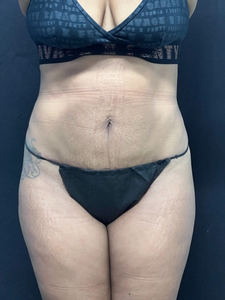 LAL-360 w/ mini tuck-after