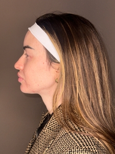 Demeri Cobb- Facial Balancing Side-after